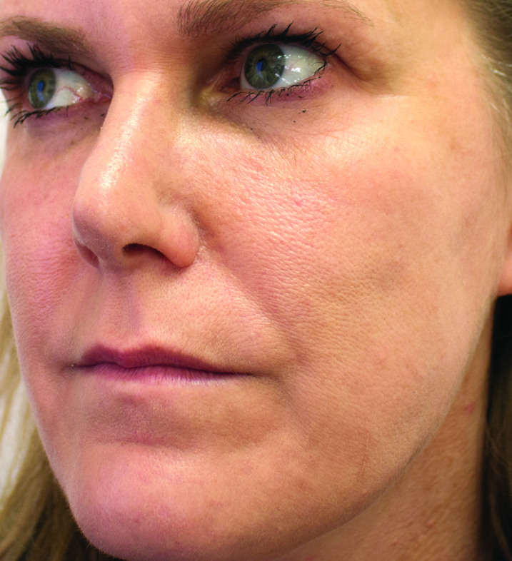 Elaine Sterling Skincare regimen results